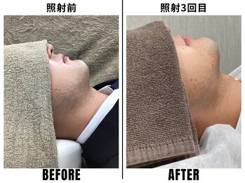 ストック 立花店(STOCK)/【ヒゲ】ヒゲ照射前→3回目