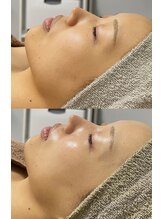 クレヴィー(Creviy)/陶肌トリートメント×光フォト