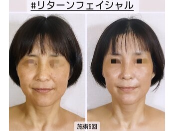 真美(Sinbi)/リターンフェイシャル