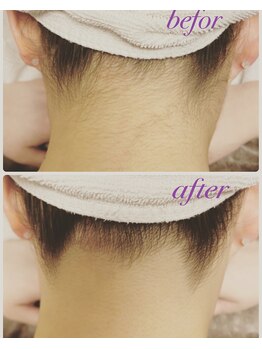 ラウレア 松山店(LAULEA)/襟足脱毛（before/after)