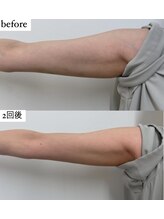 アエ メゾン(ae maison)/【施術2回】二の腕