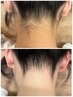 【首　うなじ脱毛　】思い通りのうなじ美人へ