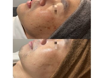 モルセラ(Moluccella)/13回の施術