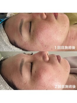 リープラス 赤坂(Re-plus)/ダーマ鍼《毛穴・ツヤ》