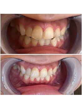 エクシアホワイトニング 代々木店/ホワイトニングで清潔感アップ