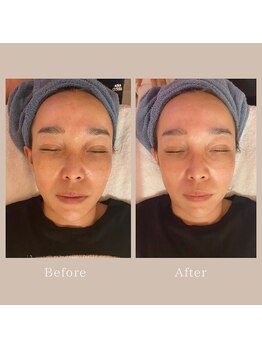 ナナイロ(nanairo)/たるみリフトアップ