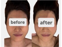 シャルム(CHARME)/《顔》インディバ