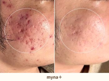 マイナプラ 表参道(myna+)/CHRISTINA/COMODEXピーリング