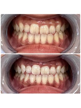 エクシアホワイトニング 日本橋店/人形町ホワイトニング