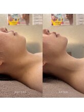 ピエルポゼ(Piereposer)/頬のもたつきすっきり！