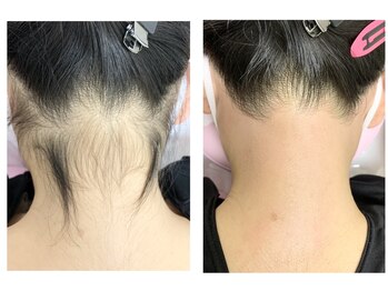 ブリリアンス(BRILLIANCE)の写真/暑くなる季節！！VIO・うなじ・脇・腕・脚・・・ボディもフェイスも気になるパーツをWAXですぐにケア♪