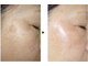 ヌー 栄(nuu)の写真/【シミ改善プログラム】3～6か月でシミ改善！驚きの劇的変化！肌全体もキレイに♪