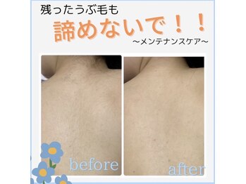 パールプラス 大村店(Pearl plus)/しつこい産毛も諦めないで!