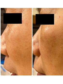 スパチャーレ(Spa ciare)/ヒト幹細胞培養上清液使用