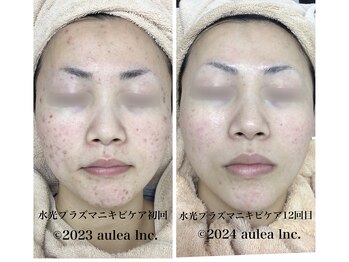 アウレア 辻堂(aulea)/毛穴洗浄＋ハーブ