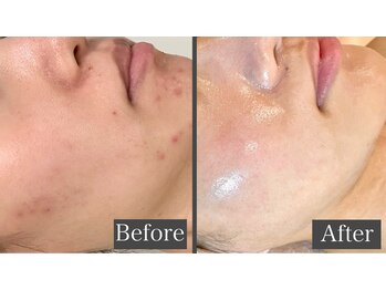 ルヴィカカリーナ(REVI Cacalena)/