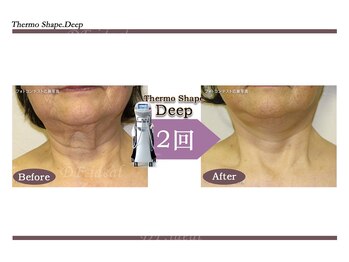 Nビューティー/最新RFサーモシェイプオーパス