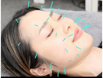 鍼灸院リンダ(鍼灸院LINDA)/40代でも遅くない!安心の美容鍼