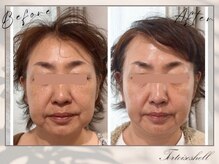 トーティシェル(tortoise shell)/小顔形成もお任せください