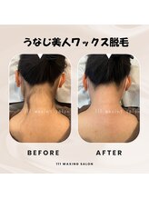 トリプルワン(111)/うなじ脱毛