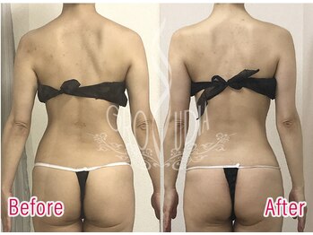 グラウディア 恵比寿/痩身/筋膜リリース/インディバ超