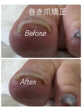 ネイルズフォーユー(Nails 4 U)/巻き爪矯正