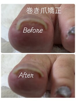 ネイルズフォーユー(Nails 4 U)/巻き爪矯正