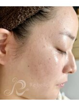 リン 長崎 大村(Rin)/after