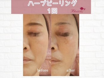 ブランリス(Blanclis)/REVIハーブ　ビフォーアフター