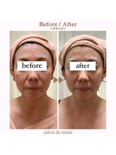 サロン ド ミミ(salon de mimi)/小顔BeforeAfter