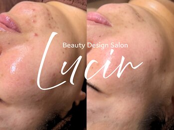 ルシール 仙台店(lucir)/<乳酸ピール> Before/After