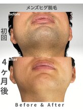 ニチワ 御器所店(NICHIWA)/ヒゲ脱毛