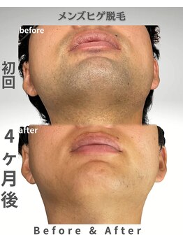 ニチワ 御器所店(NICHIWA)/ヒゲ脱毛