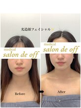 メディカルサロンドオフ 堺東店(medical salon de off)/光造顔フェイシャル★ &nbsp;施術前後