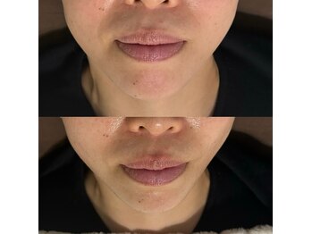 ミヨン(Miyong)/フェイスラインがキュッと!小顔