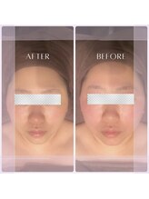 サロンド ヴィーナス 葛西店/ハイパーナイフフェイシャル小顔