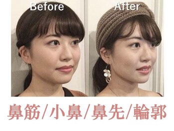 ラプリボーテ(Raplit BEAUTE)/隆鼻＋輪郭矯正40分10回