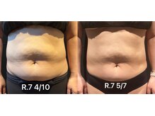 ビトタン 倉敷本店(+美to鍛)/レモンボトル3cc