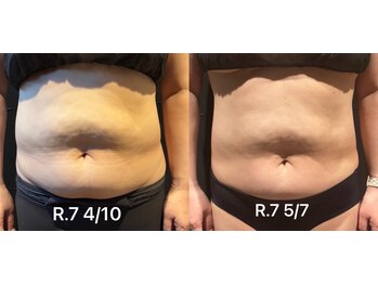 ビトタン 倉敷本店(+美to鍛)/レモンボトル3cc