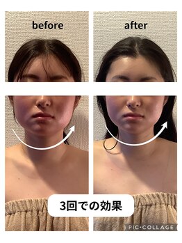 フォーリーフ(4 Leaf)/食いしばりからのエラ張り改善!