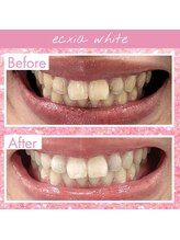 エクシアホワイトニング 札幌琴似店/ホワイトニングビフォーアフター