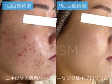 アクネラボ 梅田店(ACNE LABO)/もうニキビに悩まない！