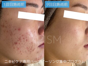 アクネラボ 梅田店(ACNE LABO)/もうニキビに悩まない！