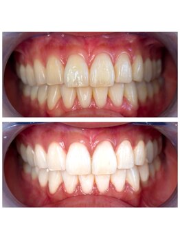 ホワイトベース(White base)の写真/22時まで営業!仕事帰りや寝る前に通えるサロン★理想の白さを目指すためにまずはお気軽にご相談ください!