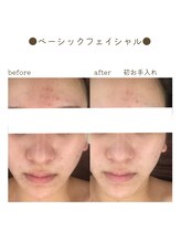 シエルブルー(ciel bleu)/美肌フェイシャル before after