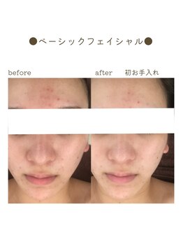 シエルブルー(ciel bleu)/美肌フェイシャル before after