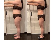 医師監修脂肪冷却お腹4カップでポッコリお腹を引き締め！