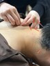 【鍼灸メニュー人気No.1】全身バランス調整オーダーメイド鍼灸　¥4980
