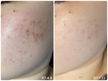 リコ(Lico)/ニキビケア