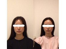 ウィル(will)/エラ張り改善。顔の整体で小顔に